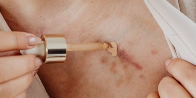 Khloé Kardashian Skin Cancer Lawsuit