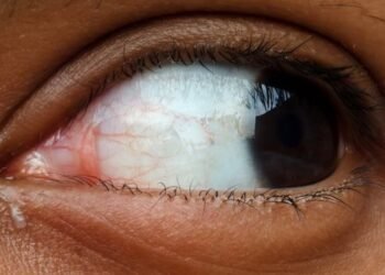 Causes of Recurring Styes in Adults