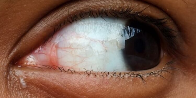 Causes of Recurring Styes in Adults