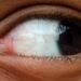 Causes of Recurring Styes in Adults